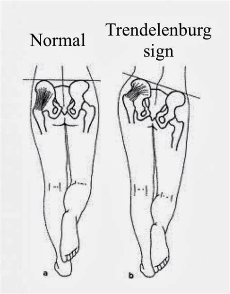 trendelenburg test vs hip drop test|trendelenburg hip exam pdf.